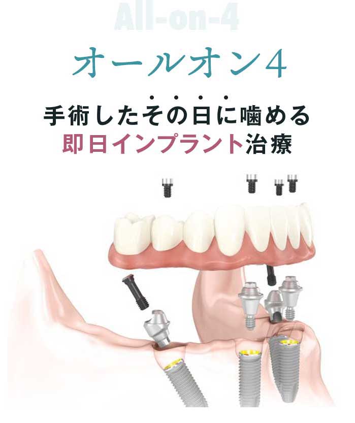 All-on-4(オールオンフォー)