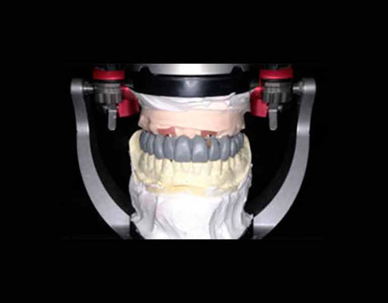 診断用模型の作成