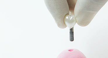 インプラント治療法