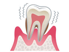 歯周病