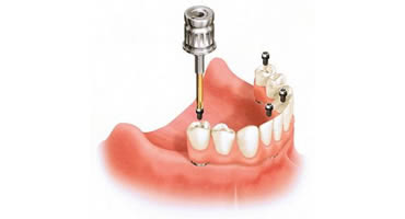 インプラント治療法