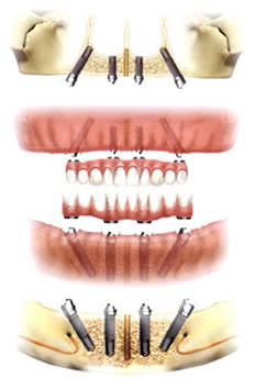 オールオン4って一体なに？