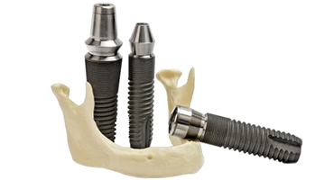 間違った位置にインプラントを埋入してしまうと起こる怖いこと