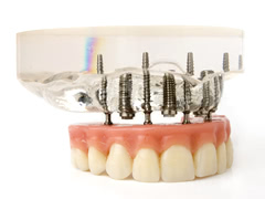 埋め込む本数が多いほど患者さんの負担が大きくなるインプラント治療