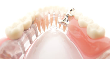 入れ歯からインプラントに変える場合