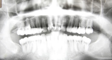 骨を移植するには