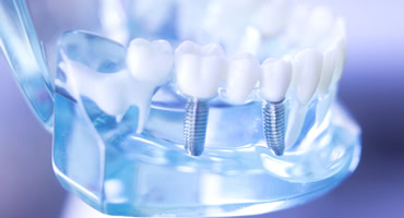 インプラントはこんな人におすすめ！