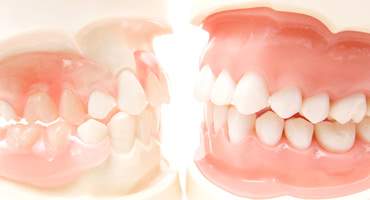 インプラントに向いていない人