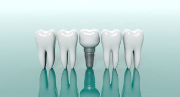 インプラントに利用される「チタン」が骨と結合できる理由