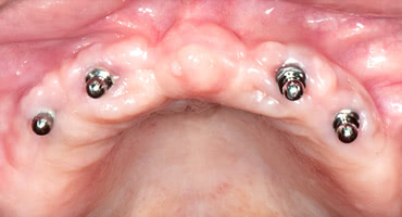 オールオン４は高額なのになぜ保険適用にならないの？