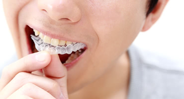 歯ぎしりや食いしばりを治す方法