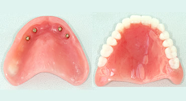 オールオン４はブリッジなのか、それとも入れ歯なのか