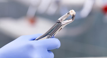 費用や抜歯など・・・オールオン4のメリット・デメリットは？