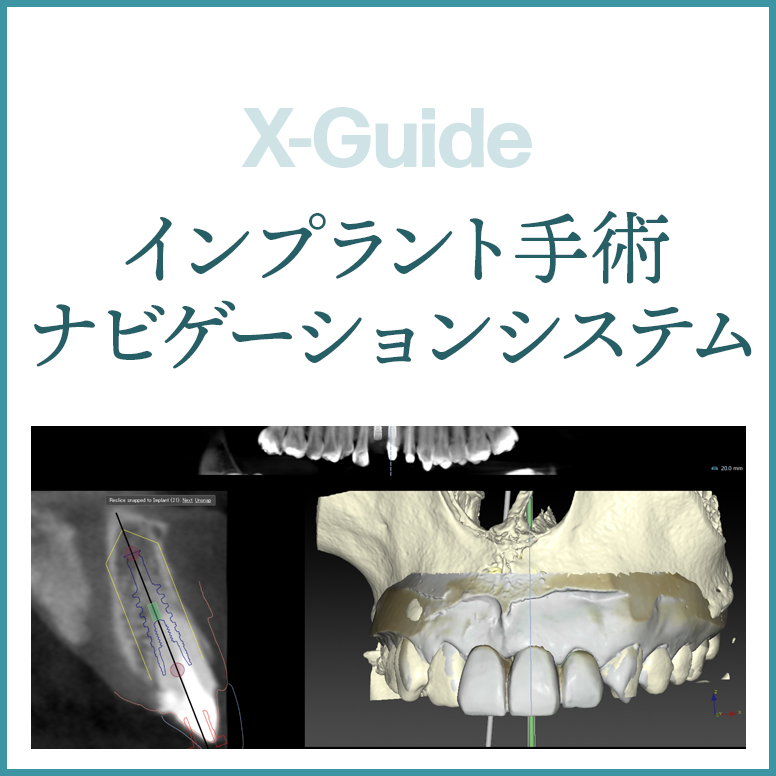 デジタルガイドインプラント