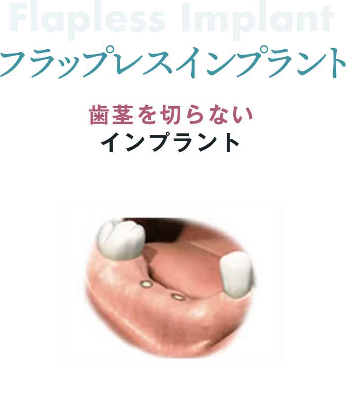 フラップレスインプラント