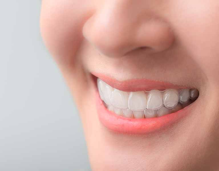 マウスピース型矯正装置