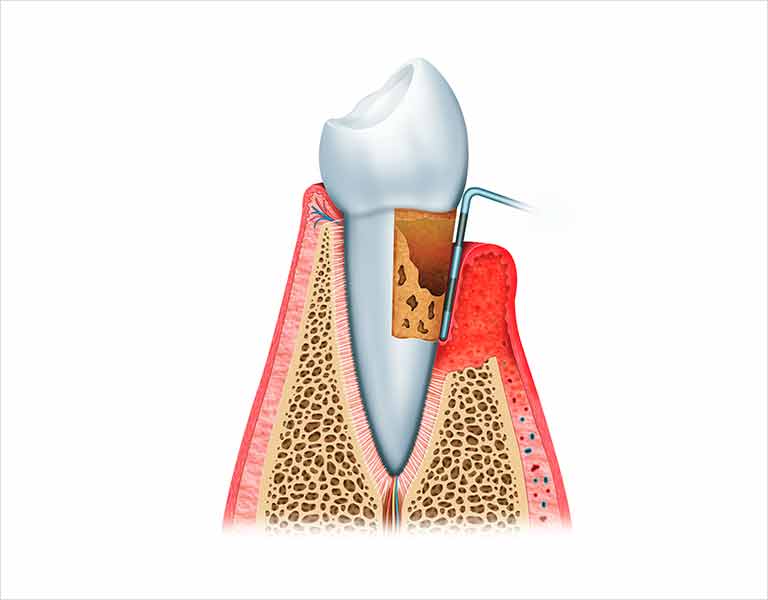 歯周病