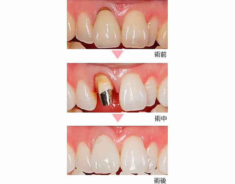 プロセラ・オールセラミッククラウン