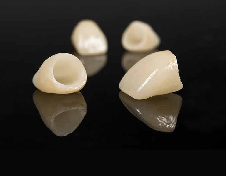 オールセラミック