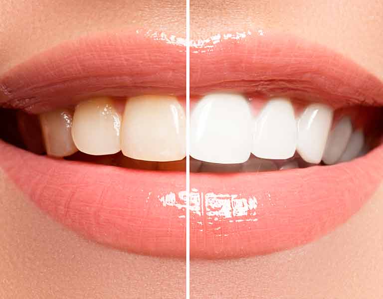 歯のホワイトニング