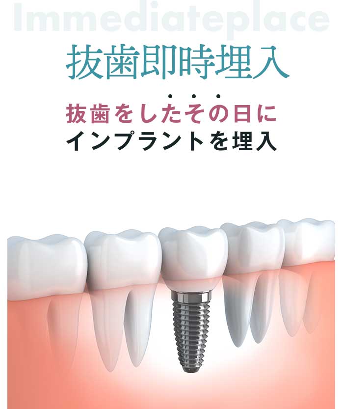 抜歯即時埋入