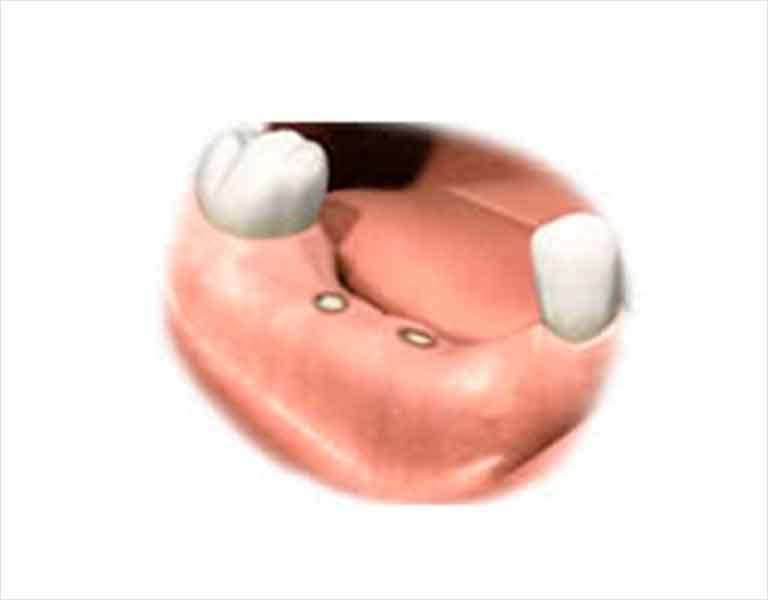 フラップレスインプラント