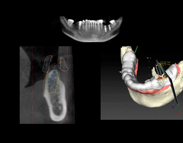 抜歯即時埋入インプラント