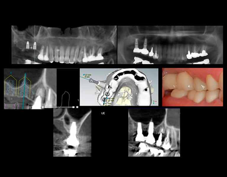 デジタルインプラント