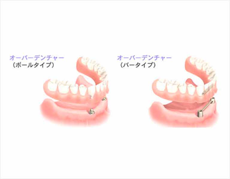 オーバーデンチャー