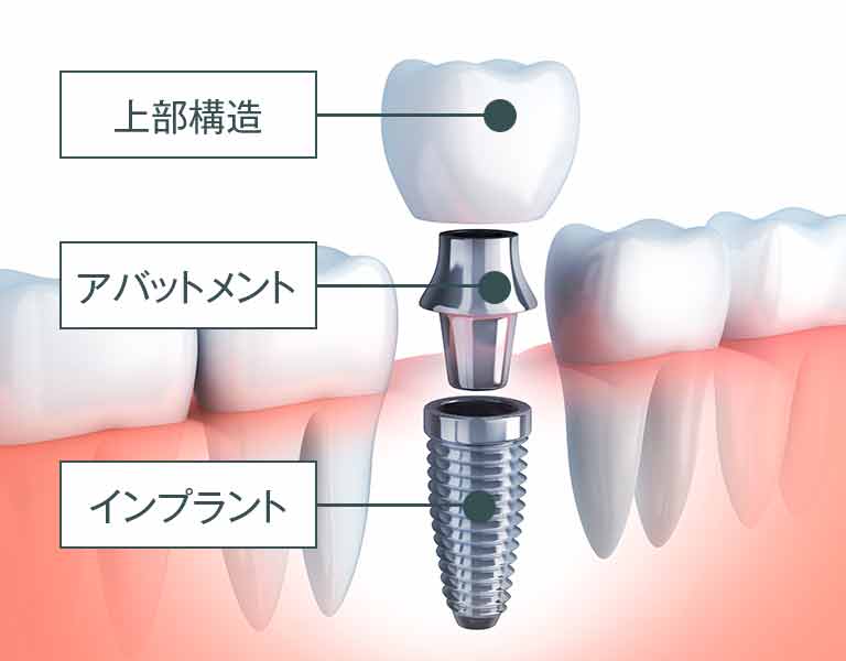 インプラントの構造