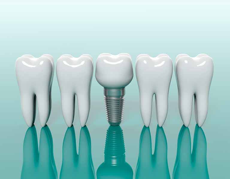 インプラント治療の安全性