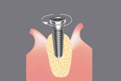 インプラントを埋める
