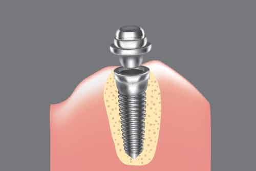 アバットメント装着