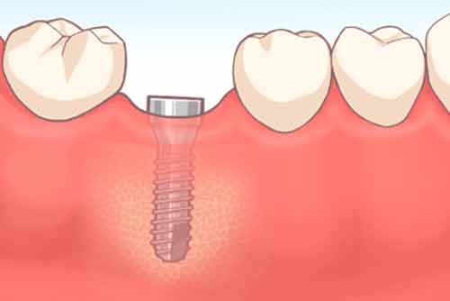 抜歯即時埋入インプラントの治療の流れ