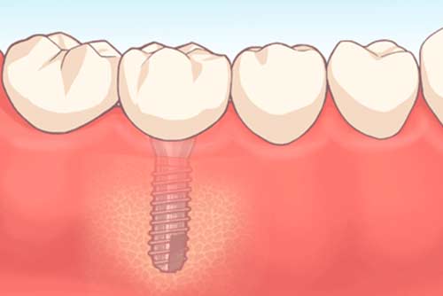 抜歯即時埋入インプラントの治療の流れ