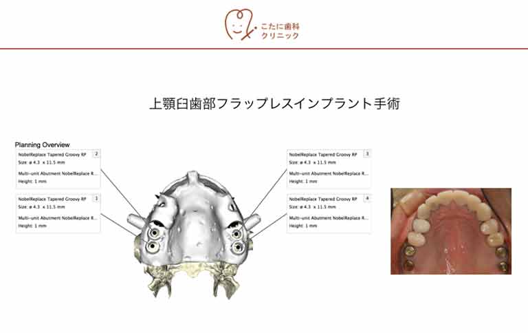 フラップレスインプラント