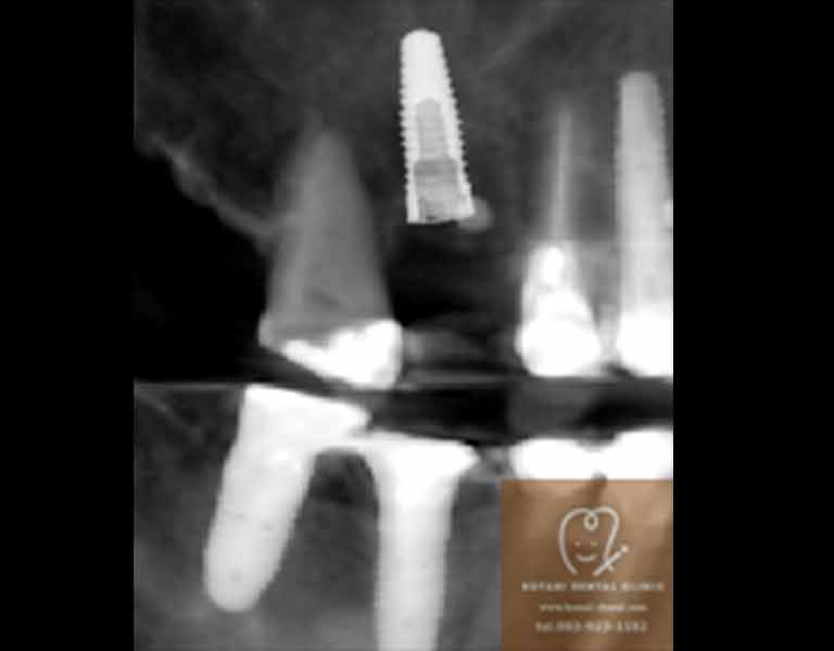 フラップレスインプラント