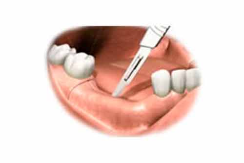 フラップレスインプラント