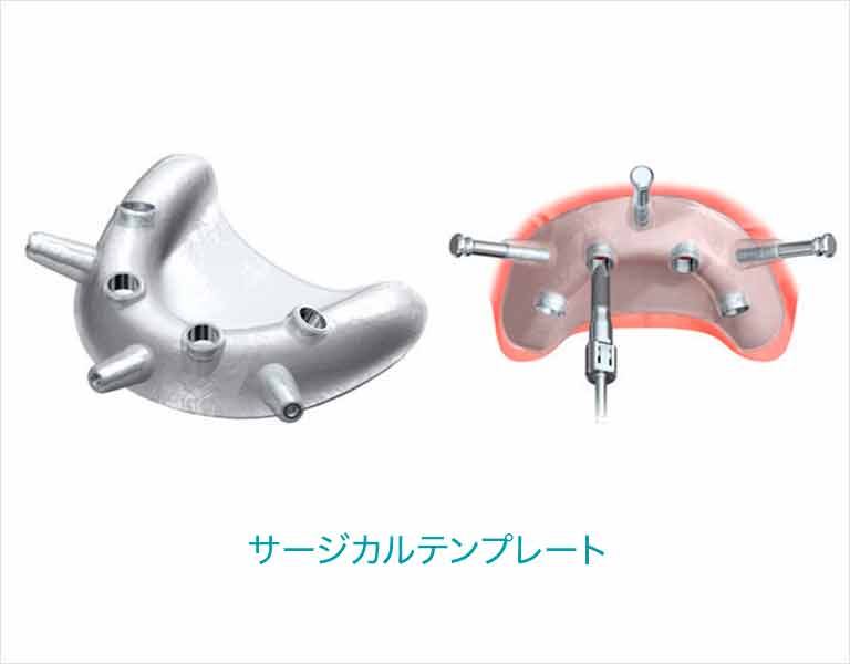 サージカルテンプレート