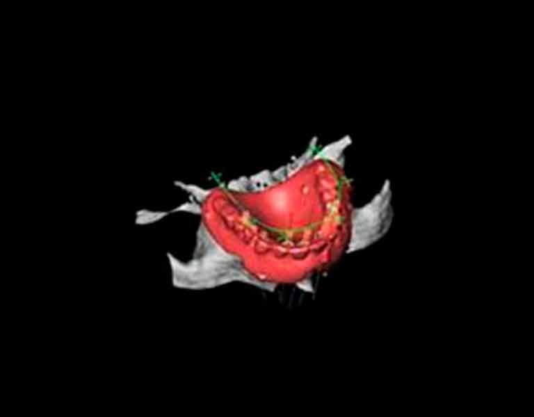 シミュレーションソフトを使用した治療計画