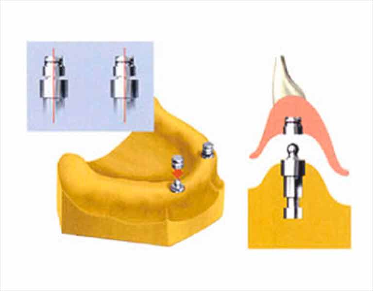 オーバーデンチャー