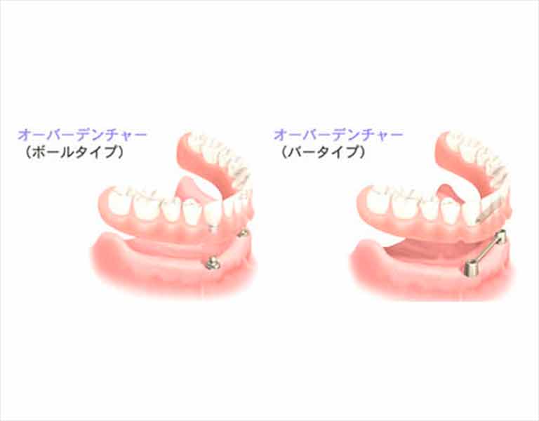 動かない入れ歯