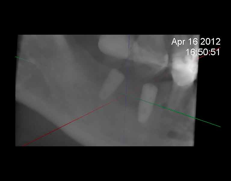 ショートインプラントとは