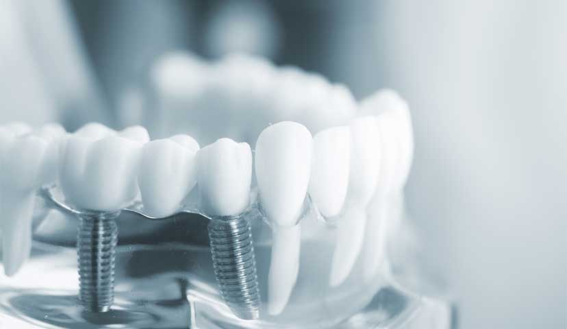 インプラントの保証期間を設定