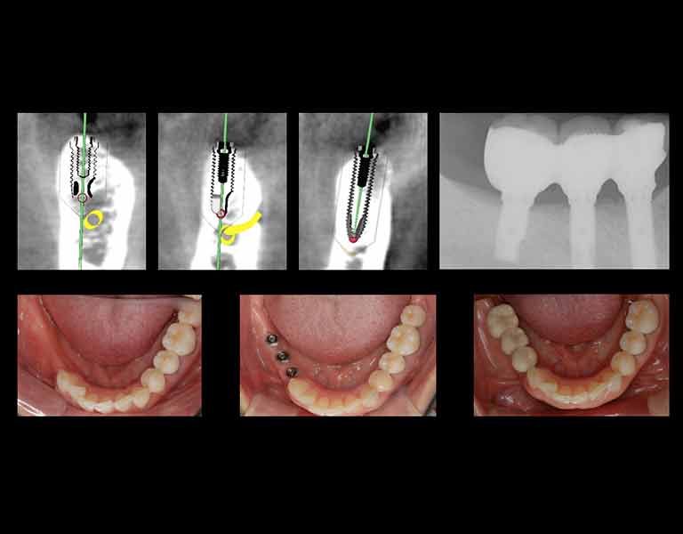 歯のレントゲン