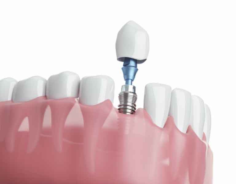 通常のインプラントの場合