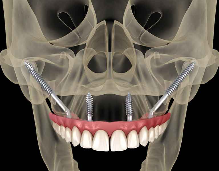 ザイゴマインプラントの場合