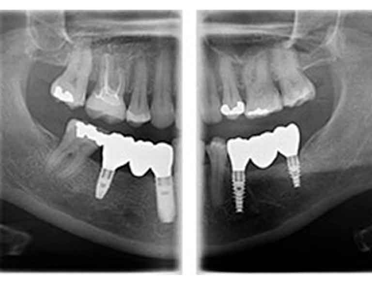 お口が開きにくい方、吐き気の強い方でも安心