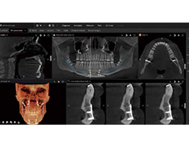 金属のアーチファクトを低減