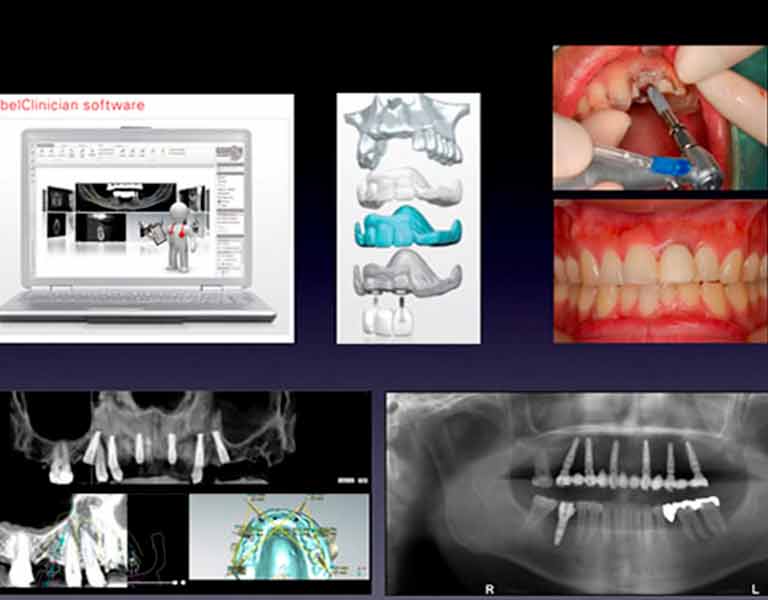 デジタルインプラント
